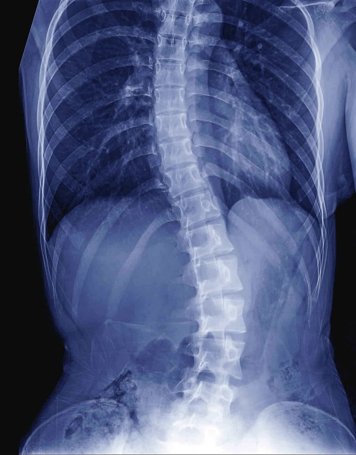 Scoliosis Test